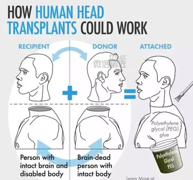 现实版《科学怪人》？人类首例“换头术”将在中国实施