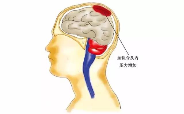 脑血管崩溃（脑溢血）前有10个信号，绝大部分人都忽略了！