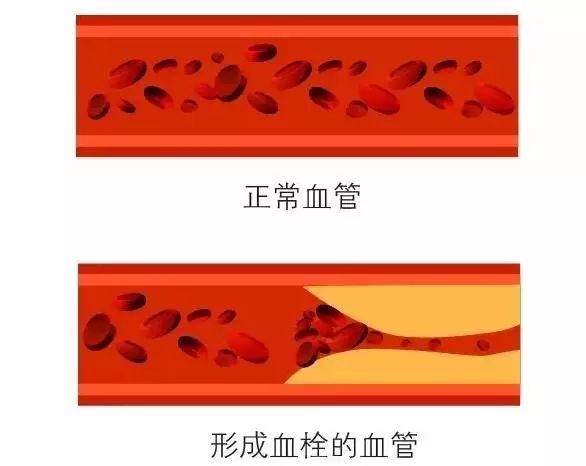 10秒钟“清理”你的血管！血栓最怕这个动作